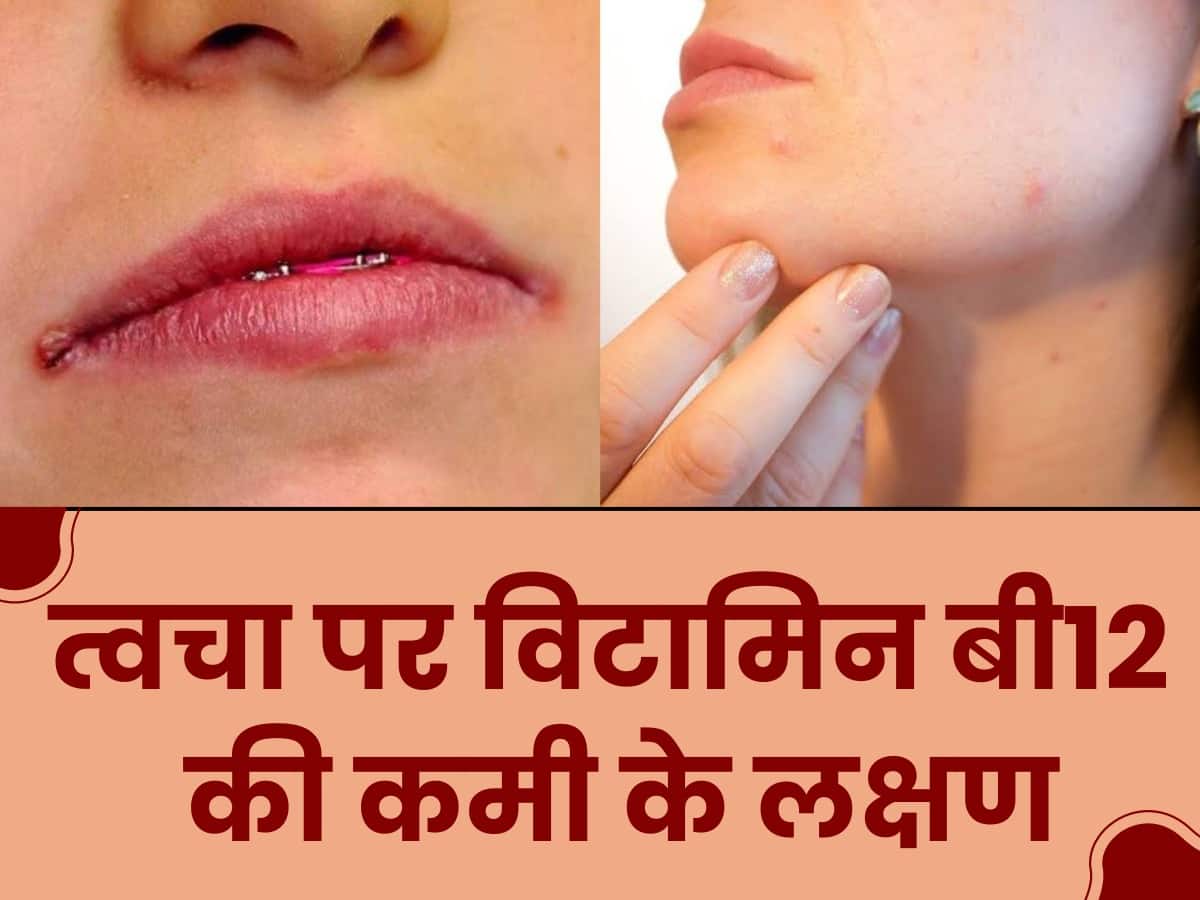 Vitamin B3 Deficiency Symptoms In Hindi