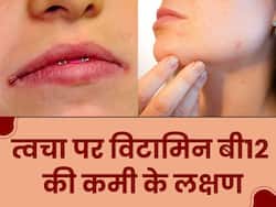 शरीर में विटामिन बी12 की कमी होने पर स्किन पर दिखने लगते हैं ये लक्षण, भूलकर भी न करें नजरअंदाज