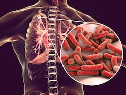 World TB Day 2024: 5 Simple Steps to Stop the Spread of Tuberculosis