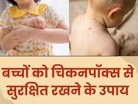बच्चों को चिकनपॉक्स के खतरे से बचाने के लिए जान लें जरूरी उपाय, बीमार नहीं पड़ेगे बच्चे बच्चों को चिकनपॉक्स के खतरे से बचाने के लिए जान लें जरूरी उपाय, बीमार नहीं पड़ेगे बच्चे