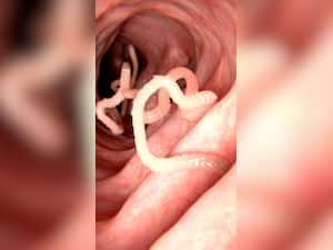 पेट के कीड़े मारने के 8 घरेलू उपाय