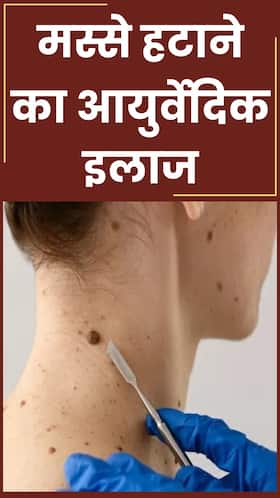 जिद्दी मस्से हटाने के 8 आयुर्वेदिक इलाज