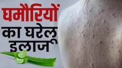 Prickly Heat Home Remedies: गर्मियों में घमौरियों का इलाज हैं ये घरेलू उपाय