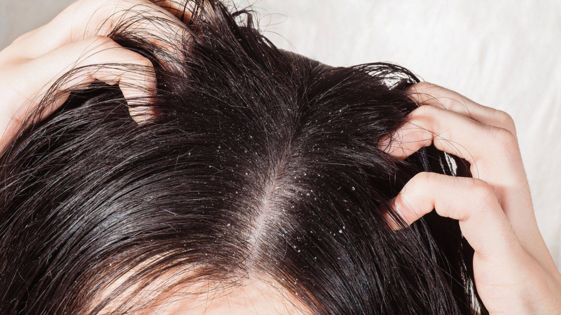 The Science Behind Dandruff: Unravelling The Causes And Solutions - Vimarsana News