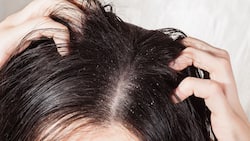 The Science Behind Dandruff: Unravelling The Causes And Solutions