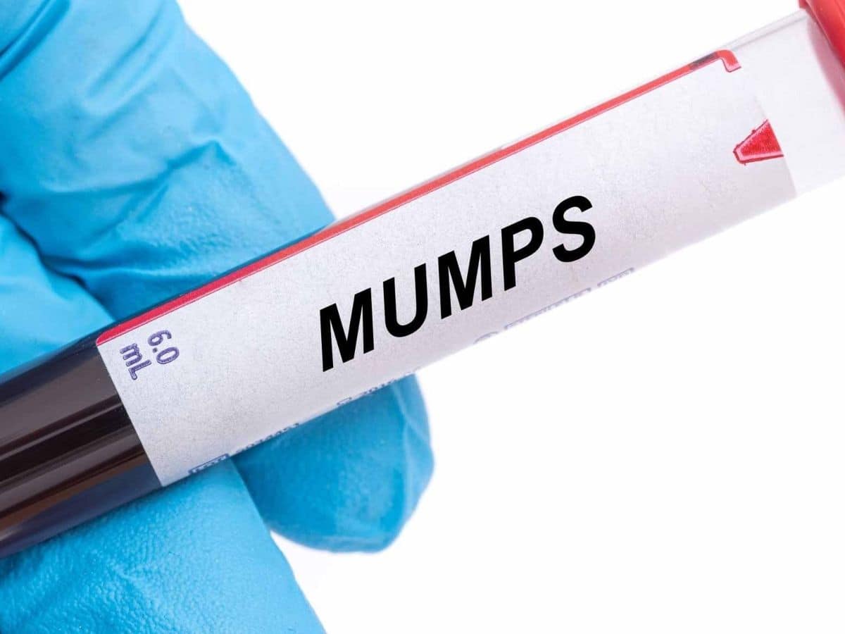 Surge in mumps cases in Delhi NCR Here are the symptoms and know how