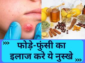 हाथ-पैरों पर दाने और फुंसी का इलाज कर सकते है ये 5 असरदार नुस्खा, रैशज और खुजली से भी पाएं छुटकारा