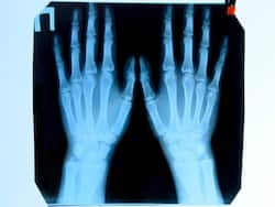 Man Who Asks Docs To Cut Off 2 Healthy Fingers Is Diagnosed With Body Integrity Identity Disorder