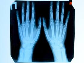 Man Who Asks Docs To Cut Off 2 Healthy Fingers Is Diagnosed With Body Integrity Identity Disorder