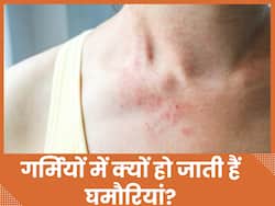 गर्मियों में इन 5 कारणों से होती हैं घमौरियां, जानिए टेम्प्रेचर जिम्मेदार है या आपकी स्किन