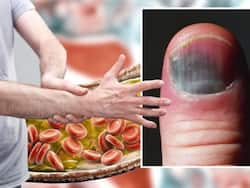 High Cholesterol Symptoms In Men 30s: Top 7 Unusual Signs Of LDL Bad Cholesterol In Hands And Fingers At Night
