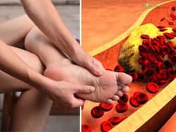 High Cholesterol Symptoms In Women 50s: Top 7 Unusual Signs of High LDL Bad Cholesterol In Legs And Feet At Night