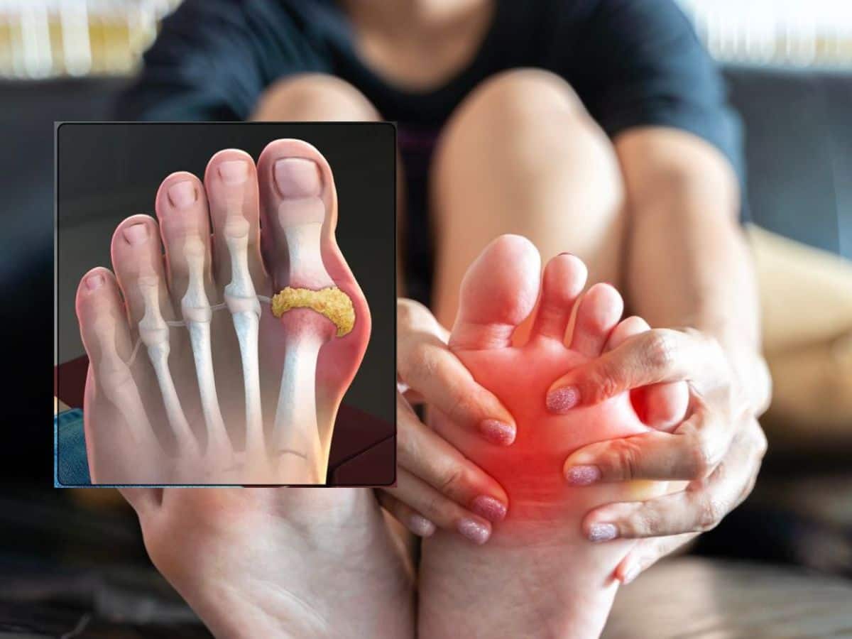 High Uric Acid Management Tips 5 Ayurveda Leaves That You Should