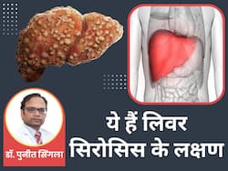 थकान और कमजोरी जैसे सामान्य लक्षण लिवर सिरोसिस के हैं संकेत, साधारण समझने की न करें गलती 