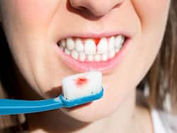 मसूड़ों से खून आना हो सकता है पेरियोडोंटाइटिस का संकेत, डॉक्टर से जानें इसके कारण और बचाव के उपाय