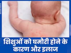 गर्मियों में शिशुओं को क्यों जाती है घमौरी? एक्सपर्ट से जानें इसे ठीक करने के तरीके