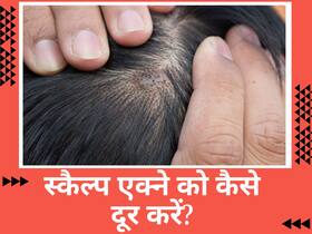 स्कैल्प एक्ने क्यों होते हैं? जानें इसे दूर करने के आसान तरीके स्कैल्प एक्ने क्यों होते हैं? जानें इसे दूर करने के आसान तरीके