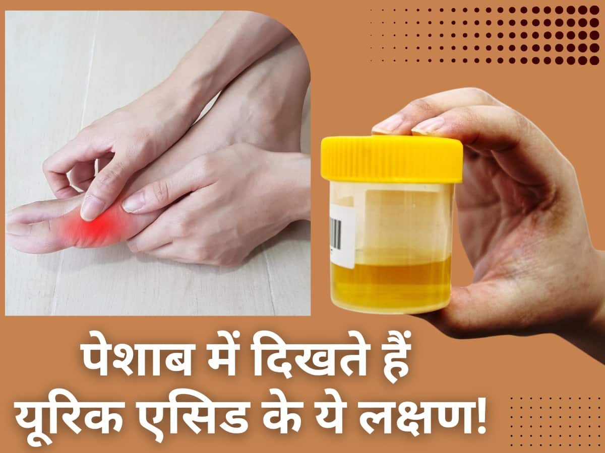 Urine Me Uric Acid Badhne Ke Lakshan यूरिक एसिड हाई होने पर पेशाब में
