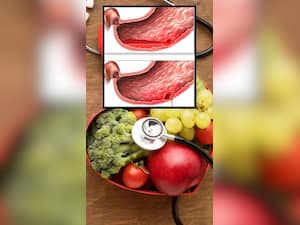 पेट में छाले होने पर कौन सी डाइट लेनी चाहिए