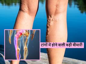 Numbness in legs: सुबह के समय पैर सुन्न रहना हो सकता है कई गंभीर बीमारियों का लक्षण, इग्नोर न करें ये संकेत