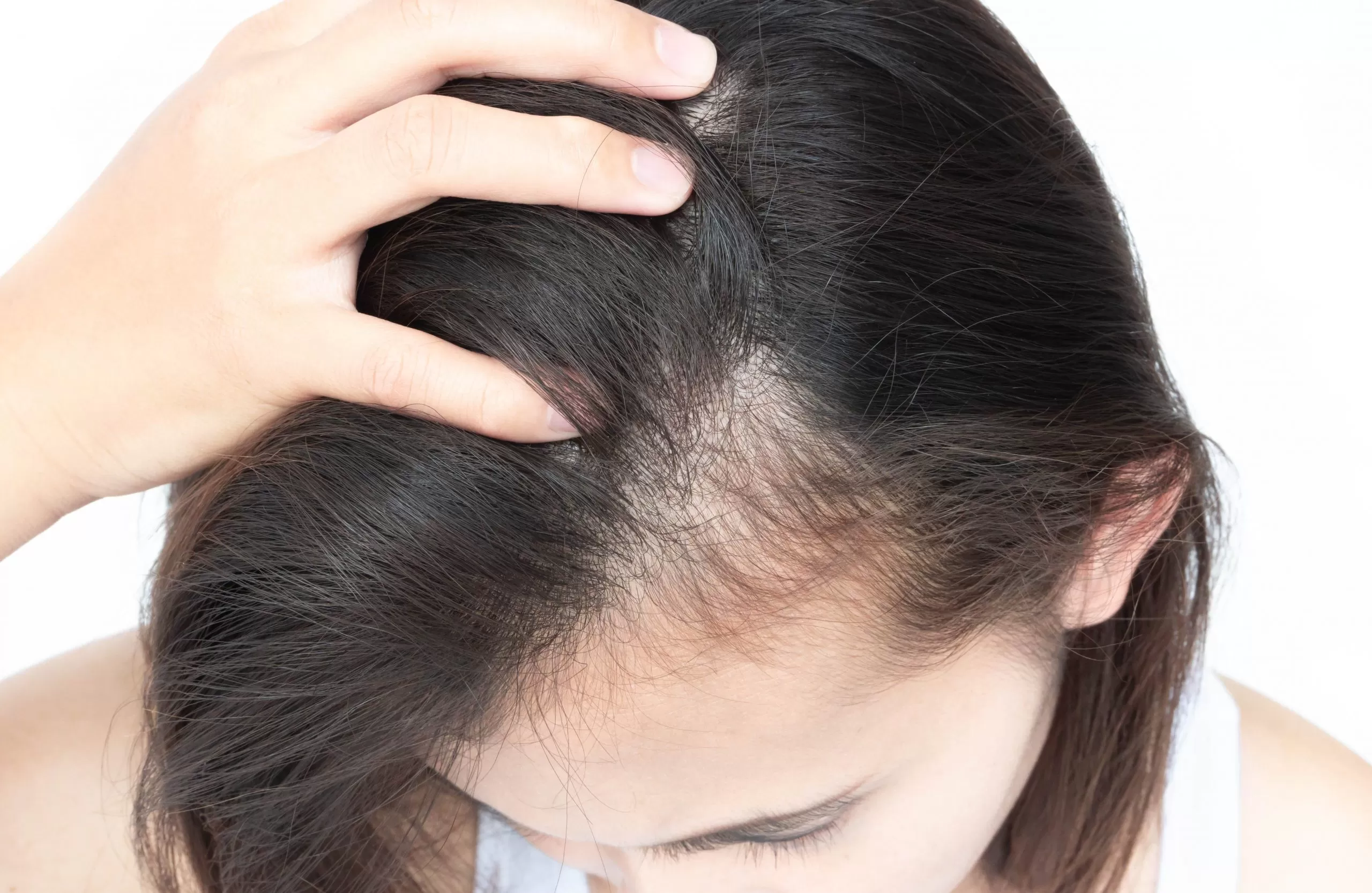 Female Pattern Baldness in Your Early 20s: Causes, Treatment, And Solutions