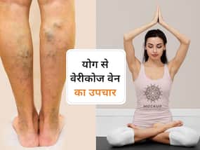 मुसीबत बन सकती हैं वैरिकोज वेन्स, योग एक्सपर्ट से जानें उभरी नसों को ठीक करने के तरीके