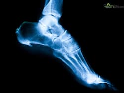 Managing Bone Spurs: Effective Strategies to Reduce Pain