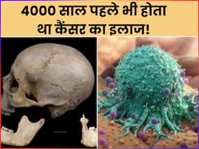 आज से ही नहीं 4000 साल पहले से ही हो रहा है कैंसर का इलाज, रिसर्च में खोपड़ी पर मिले ट्यूमर को ठीक करने के निशान! आज से ही नहीं 4000 साल पहले से ही हो रहा है कैंसर का इलाज, रिसर्च में खोपड़ी पर मिले ट्यूमर को ठीक करने के निशान!
