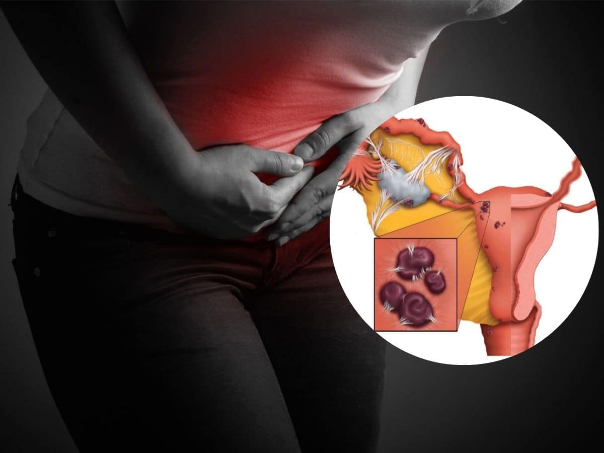 Beware Ladies! Top 5 Warning Signs Your Painful Periods Could Indicate Endometriosis