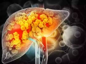 Fatty Liver: 5 Ways It Impacts Your Mental Health