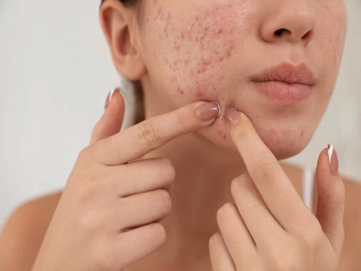 What Does The Presence Of Acne On Specific Areas Of Face Reveal About Health?