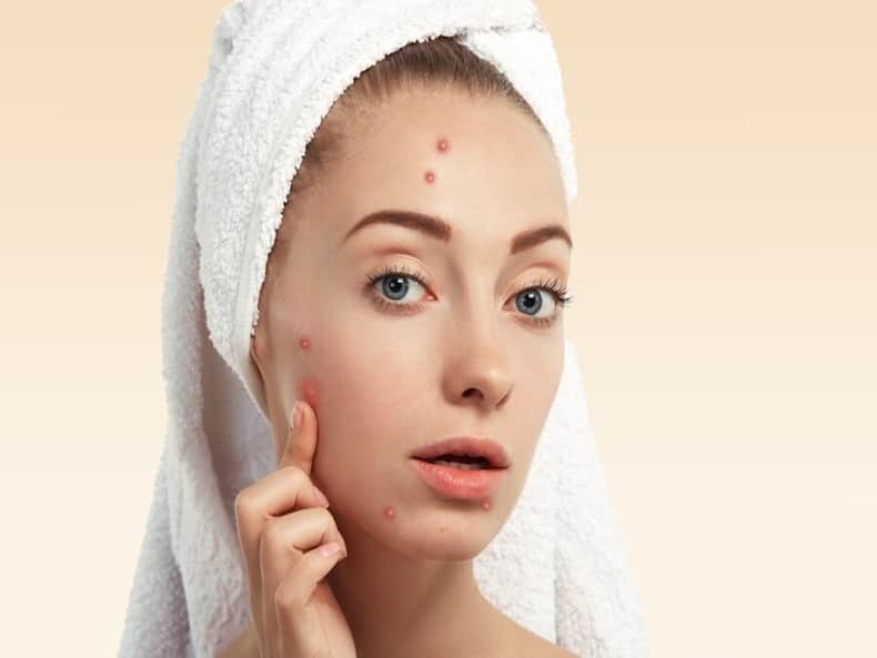 What Does The Presence Of Acne On Specific Areas Of Face Reveal About Health?