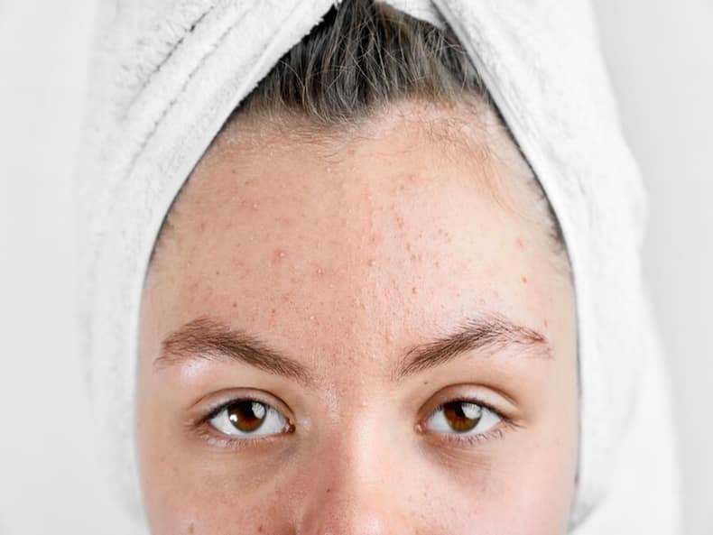 What Does The Presence Of Acne On Specific Areas Of Face Reveal About Health?