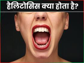 क्या है हैलिटोसिस की बीमारी? डॉक्टर से जानें इसके कारण और उपचार