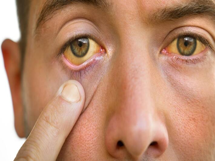 Fatty Liver Disease Symptoms: 5 Signs Of Fatty Liver Around Your Eyes ...