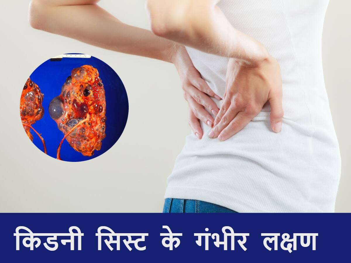 Kidney Cyst ke Lakshan शरीर के ये 5 संकेत किडनी सिस्ट की ओर करते हैं इशारा, फटने पर गंभीर हो