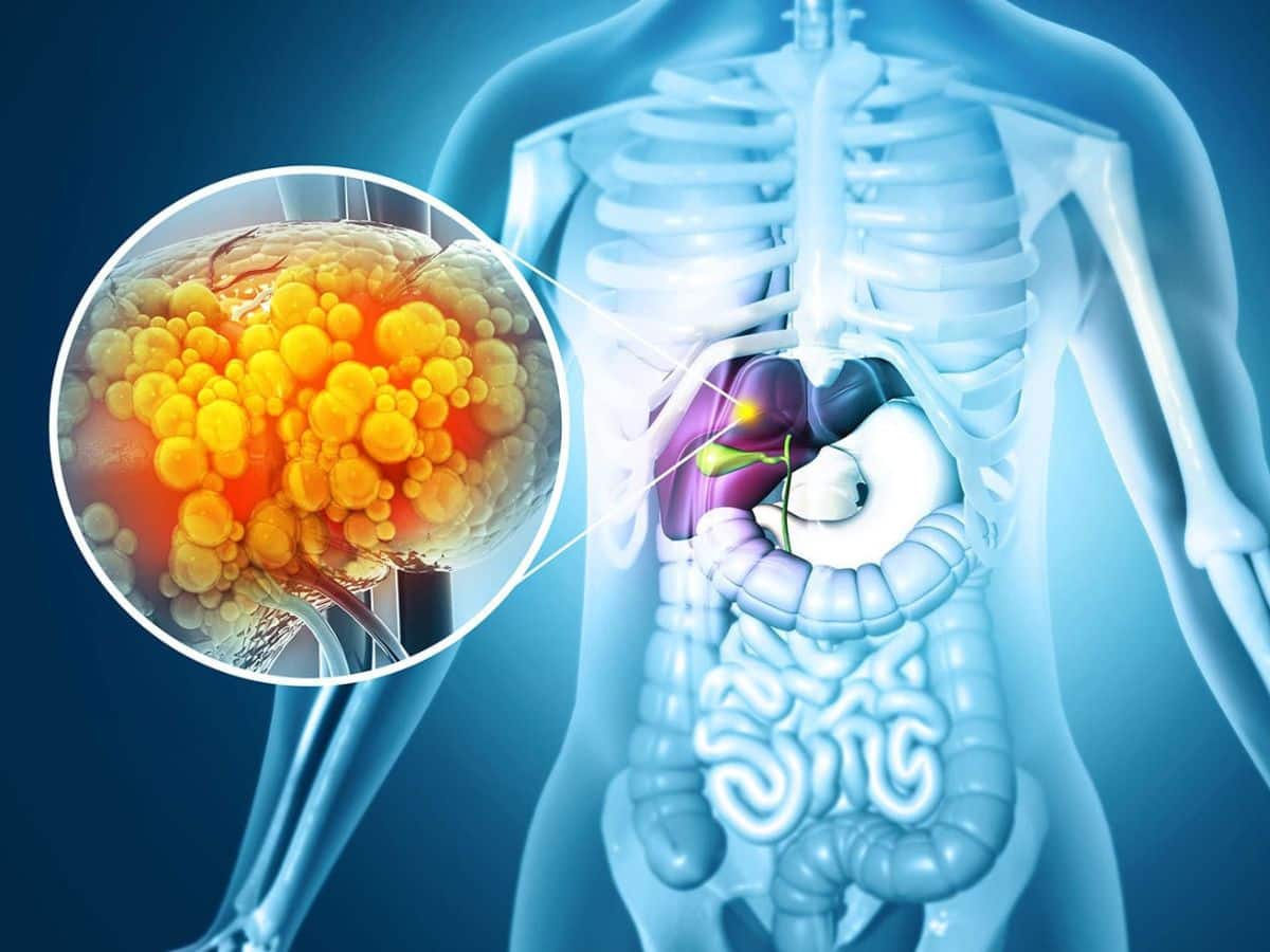 Liver Damage: Top 10 Foods To Flush Out Toxins Naturally And Prevent Liver Failure