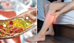 Cholesterol Inside Heart Arteries: 7 Warning Symptoms of Heart Blockage In Legs And Feet At Night Cholesterol Inside Heart Arteries: 7 Warning Symptoms of Heart Blockage In Legs And Feet At Night