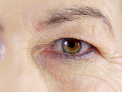 Reviving Your Gaze: Non-Surgical Solutions For Droopy Eyelids