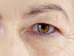 Reviving Your Gaze: Non-Surgical Solutions For Droopy Eyelids