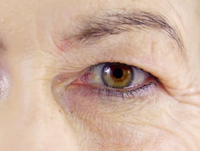 Reviving Your Gaze: Non-Surgical Solutions For Droopy Eyelids