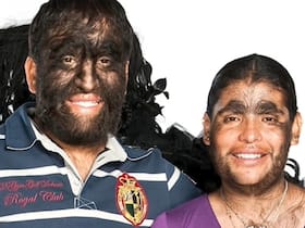 Guinness World Records: 'Largest Hairy Family' Suffers From Rare 'Congenital Generalized Hypertrichosis' Condition