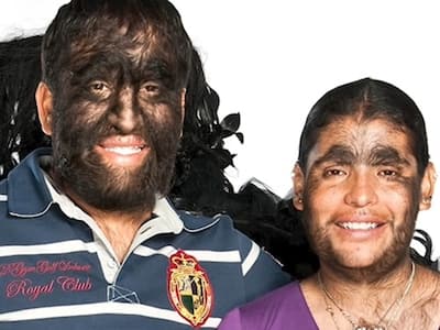 Guinness World Records: 'Largest Hairy Family' Suffers From Rare 'Congenital Generalized Hypertrichosis' Condition