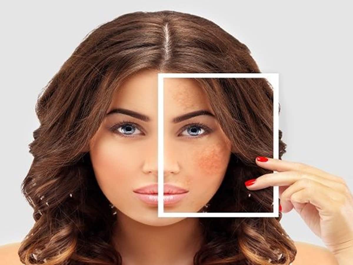 Avoid Hyperpigmentation In Summer With Exclusive Tips From Shahnaz Husain