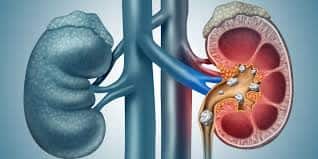 What Are Common Causes Of Kidney Stones, And How Can We Prevent Them ...