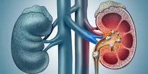 What Are Common Causes Of Kidney Stones, And How Can We Prevent Them?