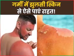 चिलचिलाती धूप से झुलस गई है आपकी स्किन तो अपनाएं ये 3 असरदार नुस्खे, मिनटों में मिलेगा आराम
