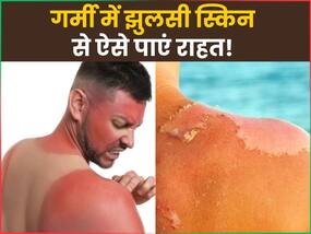 चिलचिलाती धूप से झुलस गई है आपकी स्किन तो अपनाएं ये 3 असरदार नुस्खे, मिनटों में मिलेगा आराम