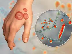 दाद-खाज, खुजली से राहत पाने के लिए अपनाएं इन 5 में से कोई भी 1 नुस्खा, तुरंत मिलेगा आराम