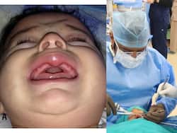 होठों पर ट्यूमर के साथ जन्मे बच्चे की हुई सफलता पूर्वक सर्जरी, इस खास टेक्निक का किया गया इस्तेमाल